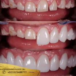 before after results of dental veneers