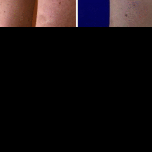 before after results of spider veins treatment