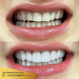 best dental veneers near me Islamabad