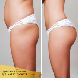 cost of Buttock Fillers in Islamabad