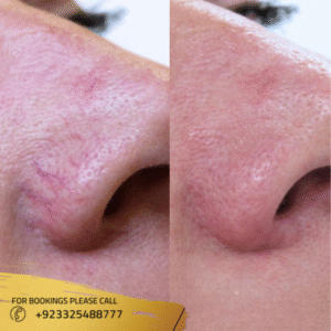 cost of spider veins treatment in islamabad