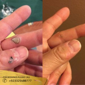 cost of warts removal in islamabad