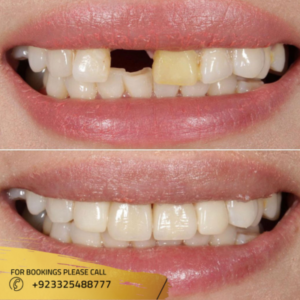 dental implants near me - F7 Markaz