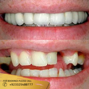 guaranteed results of dental implant in islamabad