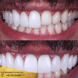 procelain veneers results before after