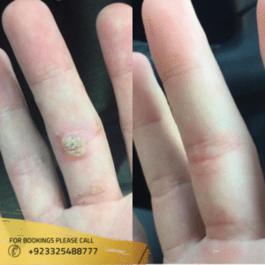 results of warts removal