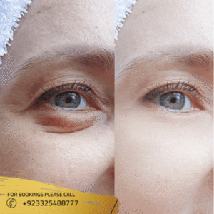 Cost of Eyelid surgery in Pakistan