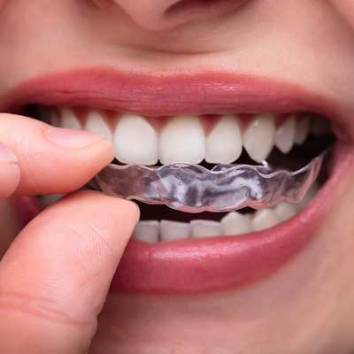 Cost of Mouth/Night Guards Splints in Islamabad