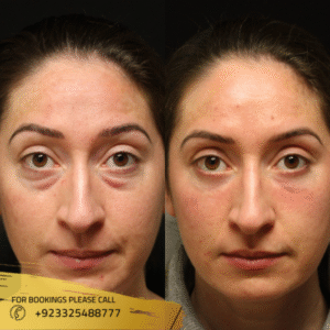 Eye lid Surgery Before After Results