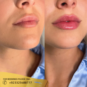 best Dermal filler injections in islamabad