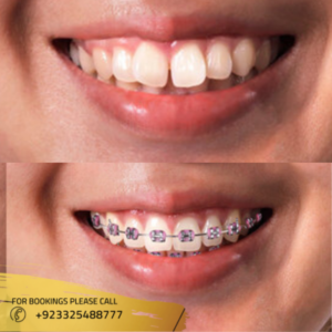 dental braces before after results