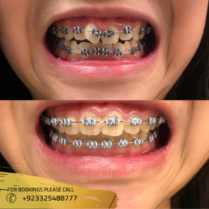 dental braces cost in islamabad