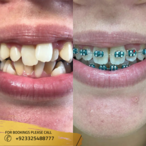 dental braces in islamabad, pakistan
