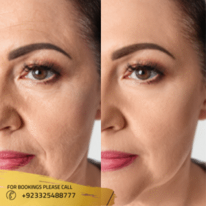 facelift Treatment before after results