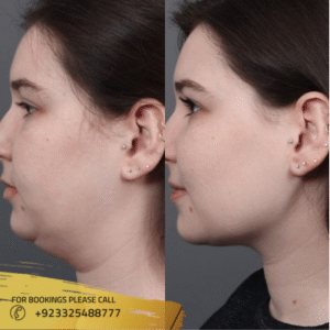 neck liposuction before after results