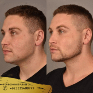 neck liposuction cost in islamabad