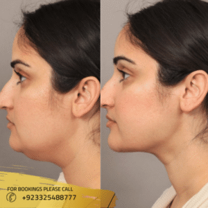 neck liposuction in islamabad , pakistan