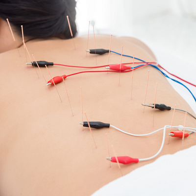 Electro Acupuncture Treatment in Islamabad