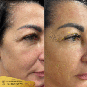 HIFU Treatment cost in Islamabad Pakistan - hifu before and after