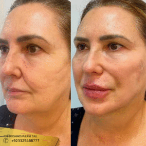 HIFU Treatment in Islamabad