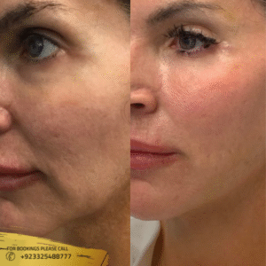 Hifu face lift before and after