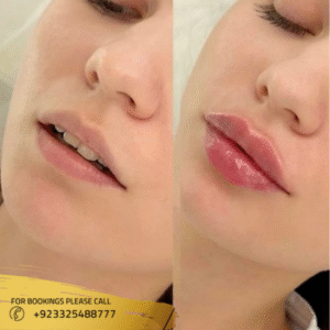 Lip fillers before and after by Dr Ayusha Khan