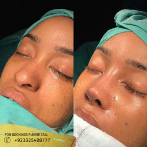 Non Surgical Nose Job before and after - Dr Ayusha Khan