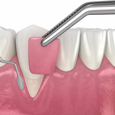 Pinhole Surgery in Islamabad