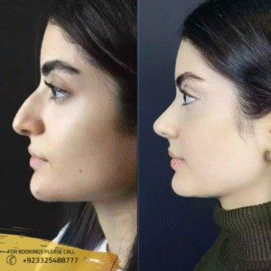 alarplasty before and after