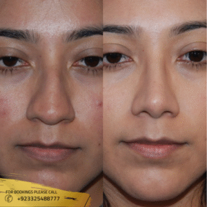 alarplasty before and after cost