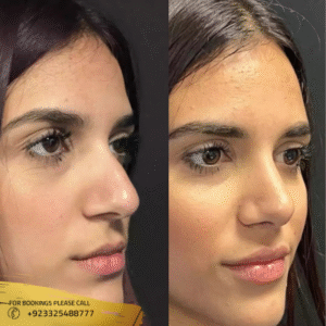 alarplasty in islamabad results