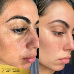 before after results of chemical peel treatment