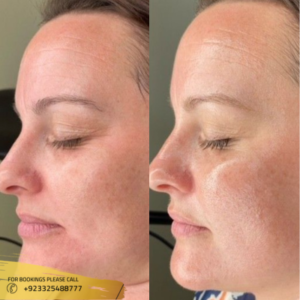 chemical peel treatment in islamabad