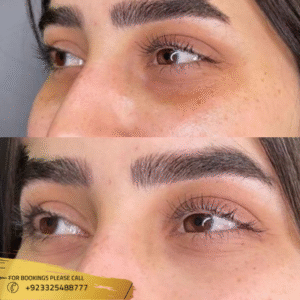 dark circles treatment before and after