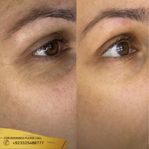 dark circles treatment in islamabad pakistan