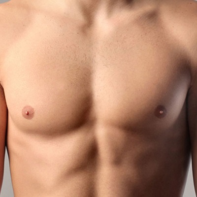 What are the benefits of removing gynecomastia