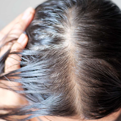 Which Hormone Causes Hair Loss in Females?