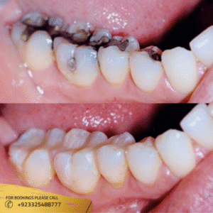 composite fillings before and after