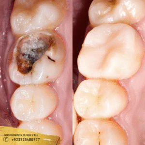 teeth filling in islamabad pakistan