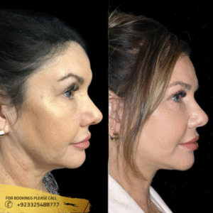 thread lift cost in islamabad pakistan