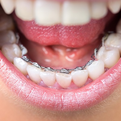 How Often do Lingual Braces Need Tightening?