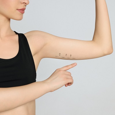 What is The Procedure For Arm Skin Tightening?