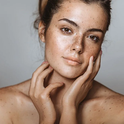 When does hyperpigmentation start