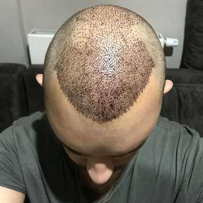 Best Clinic for Hair Transplant Near F6 Islamabad