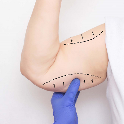 Can underarm fat be removed through arm lift treatment
