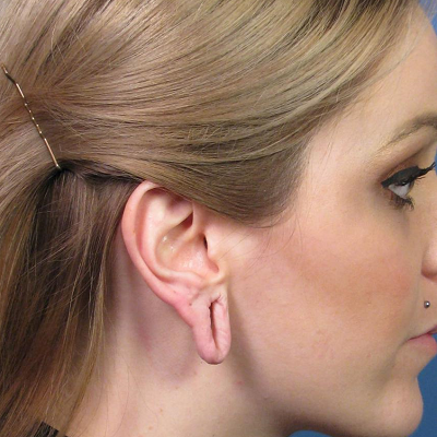 Can we reduce a hole in the ear with otoplasty?