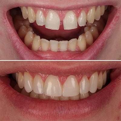 Composite Bonding in islamabad