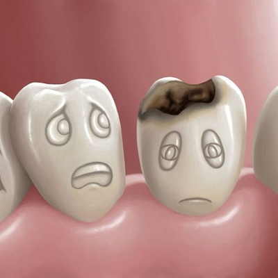 Do cavities go away after a dental filling?