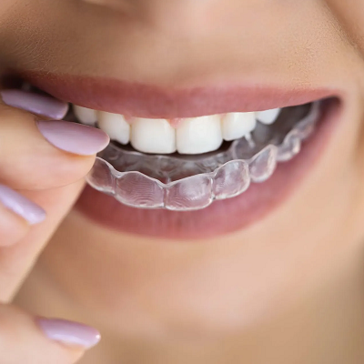 Do's and Don'ts of Dental Aligners