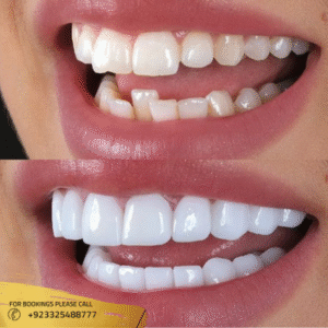 Teeth Aligners before and after